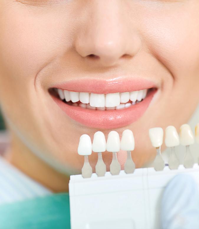 Closeup of smile compared with teeth whitening shade chart